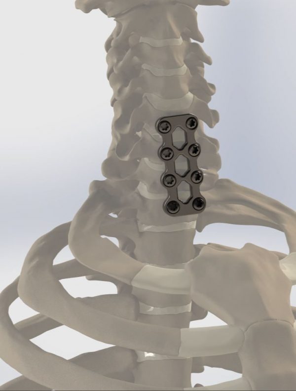 Polysegmental system of ventral fixation of the cervical and thoracic spine